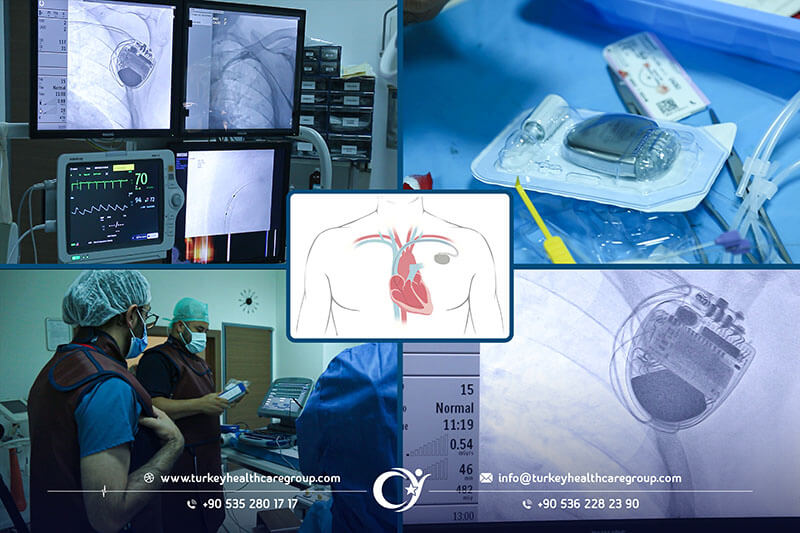 عملية تركيب جهاز بطارية القلب زراعة جهاز تنظيم ضربات القلب في تركيا