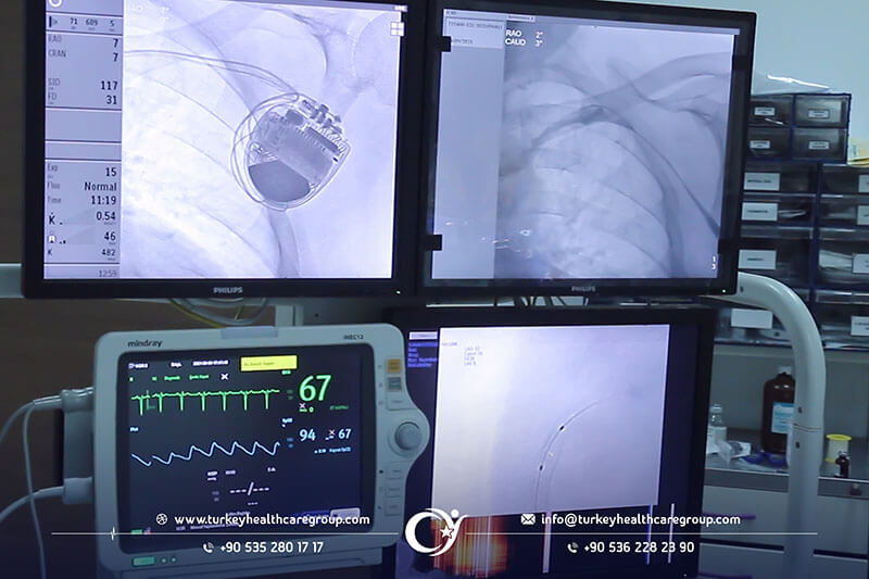 عملية تركيب جهاز بطارية القلب  زراعة جهاز تنظيم ضربات القلب  في تركيا