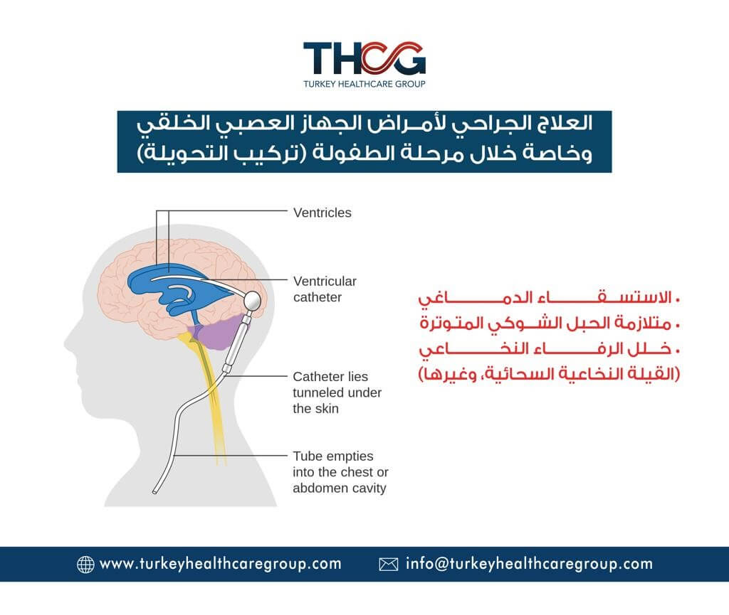 جراحة المخ والأعصاب للأطفال