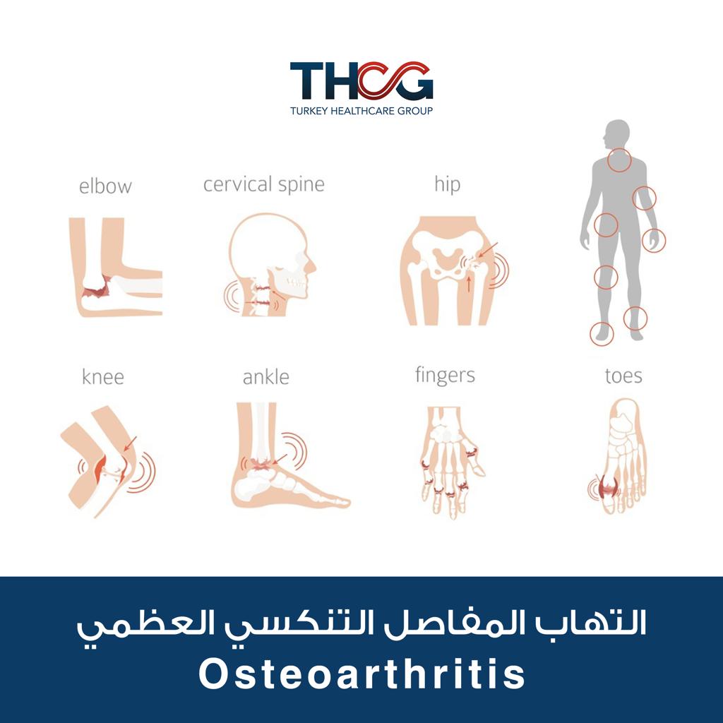 التهاب المفاصل التنكسي العظمي (Osteoarthritis)