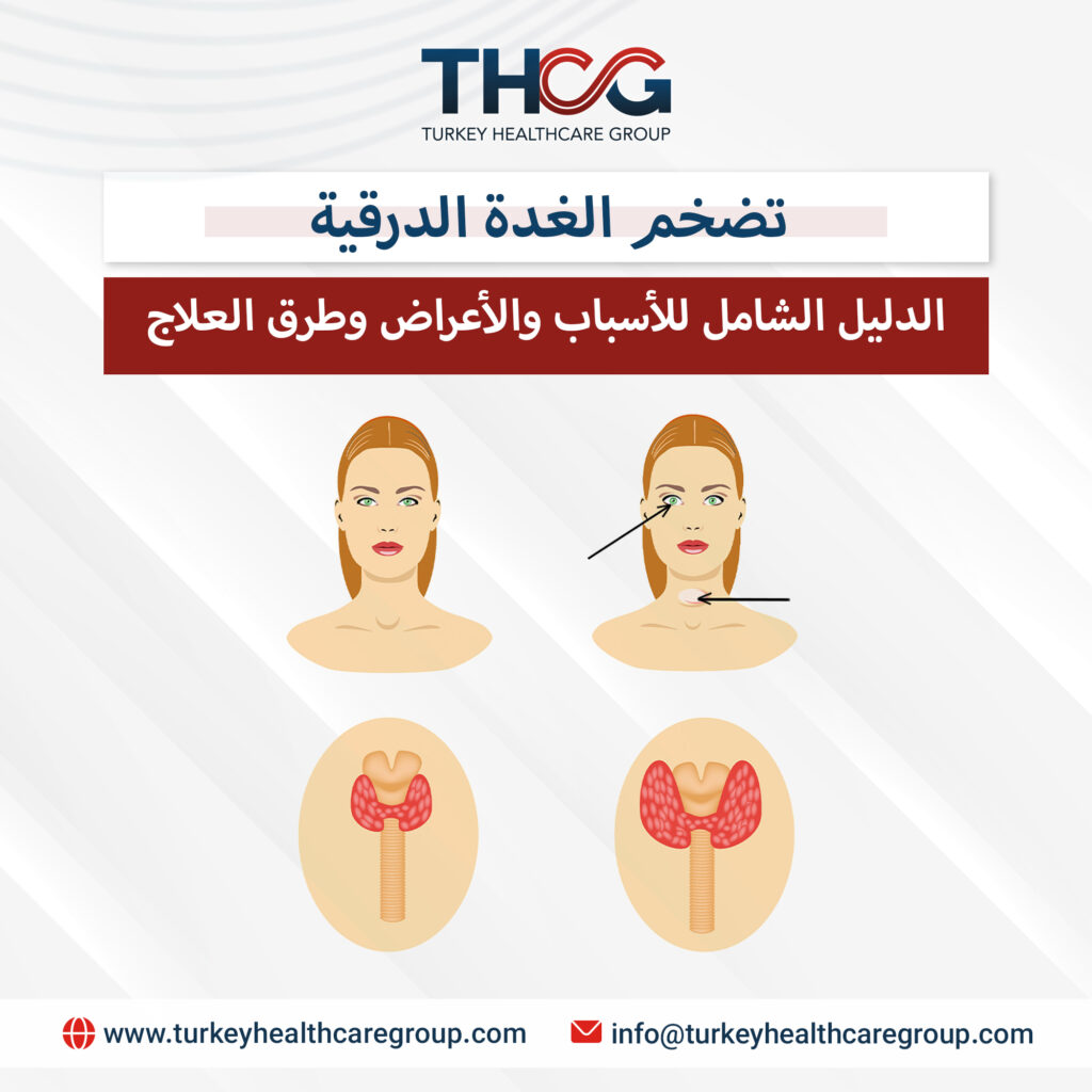 تضخم الغدة الدرقية