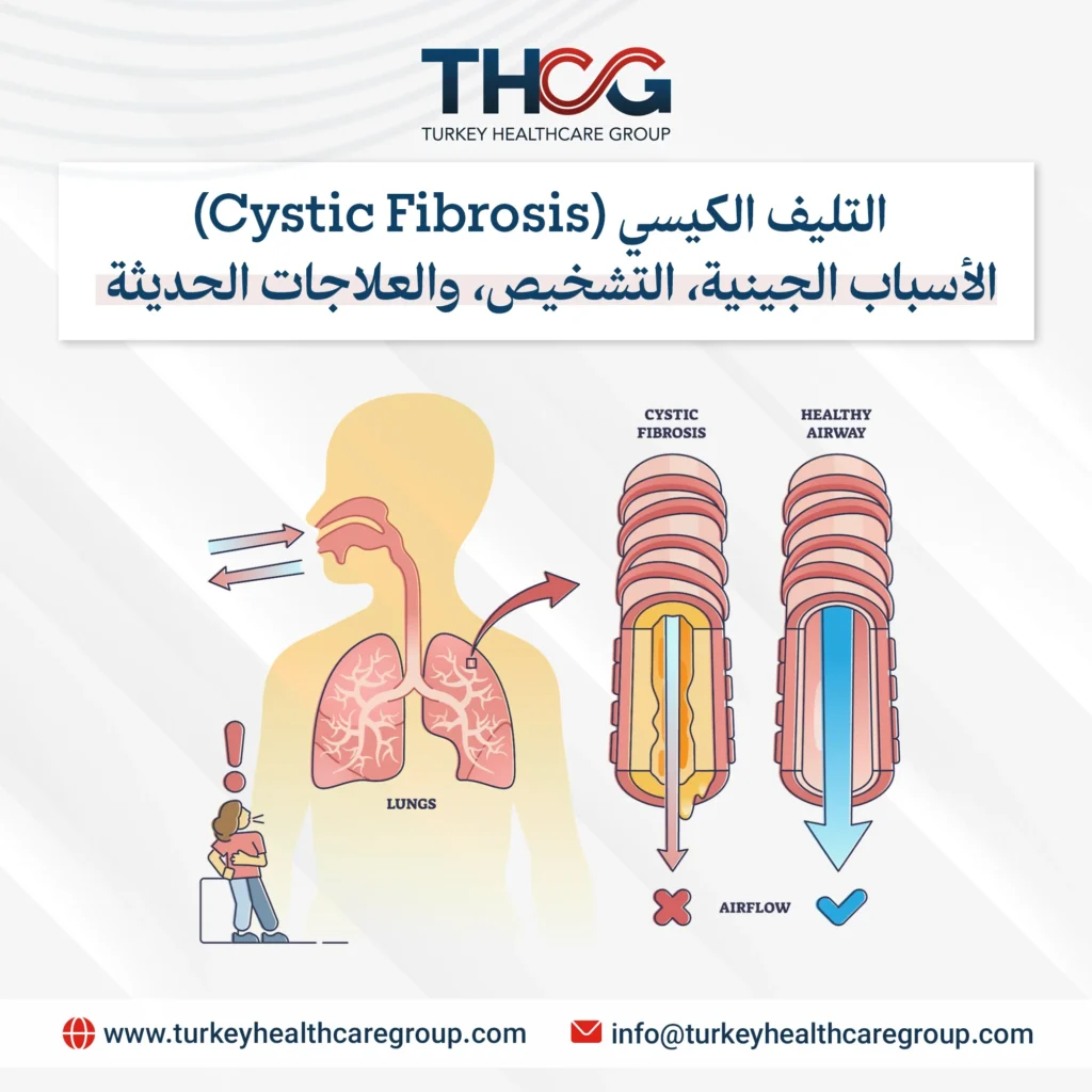 حقائق أساسية عن التليف الكيسي